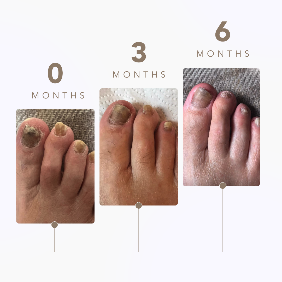 Nail Fungus Laser Device