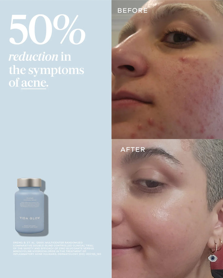 Clear Capsules Acne Supplement